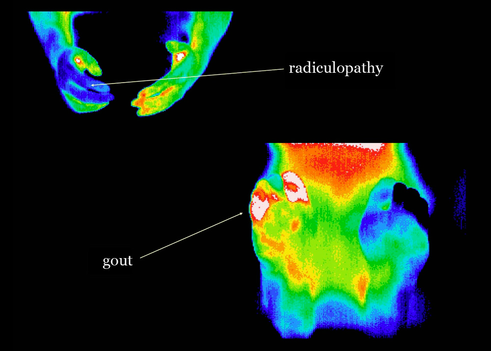 PET, CT Scans, and Thermagraphy for Breast Cancer Imaging